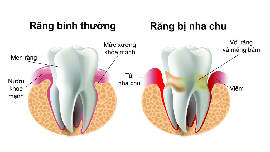 Tác hại của vôi răng