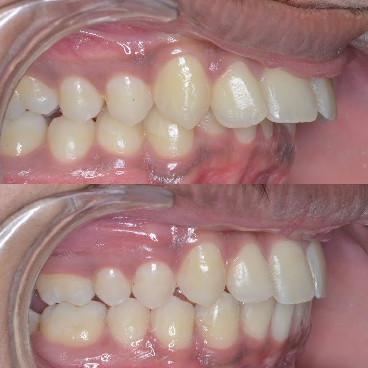 Bọc răng sứ khắc phục tình trạng răng chìa ra trước