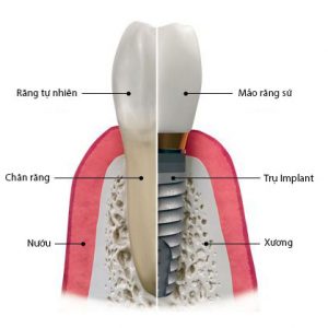 Implant và răng thật
