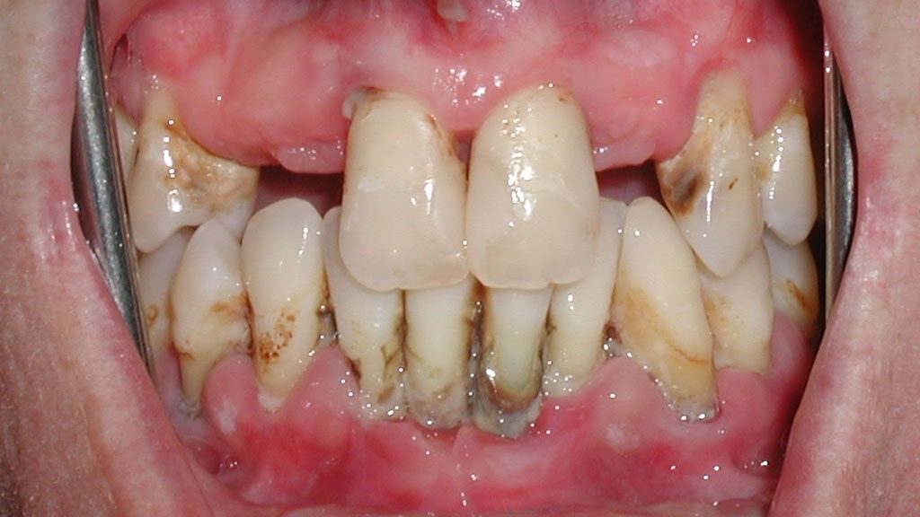 Cần điều trị nha chu trước khi trồng răng giả