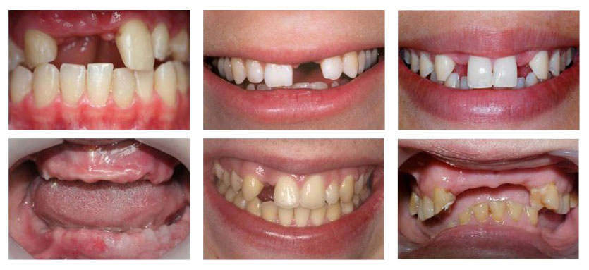 Những trường hợp nên trồng răng giả
