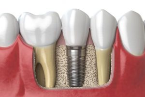 Implant có chức năng như một chân răng thật