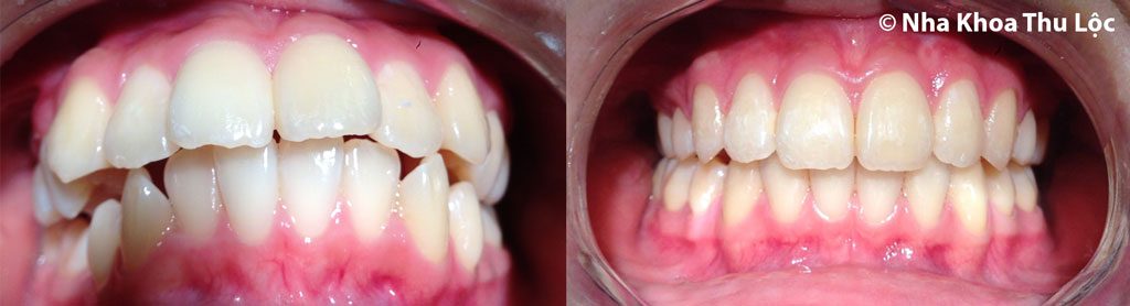 Trước và sau niềng răng