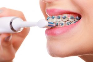 Chăm sóc răng miệng khi niềng răng