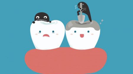 The-Role-of-Dental-Sealants-in-Tooth-Decay-Prevention-f